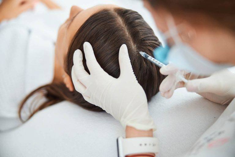 PRP ACELL MICRONEEDLING FOR HAIR LOSS