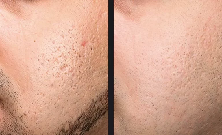 exceed-acne-scars-p1-mtderm.jpg